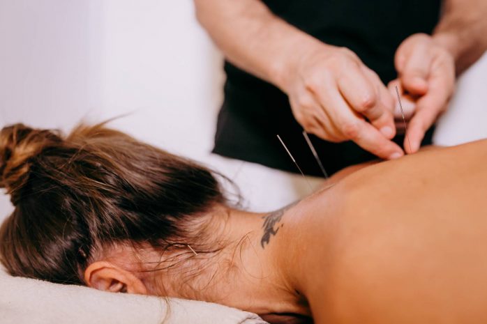 acupuncture-session